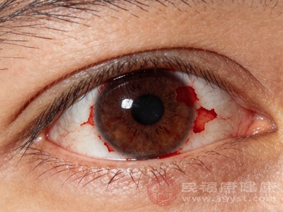 若红血块同时伴有眼睛疼痛、视力下降、视物模糊、畏光、流泪、眼睛分泌物增多等症状，可能是角膜炎、青光眼等眼部疾病的表现