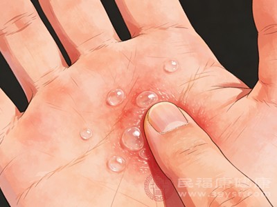 汗疱疹伴手部多汗、脱皮，瘙痒程度不一，病程复发性强，季节交替时易发作