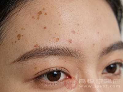 化学剥脱法适用于较轻的老人斑，操作相对简单