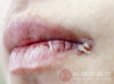嘴巴突然起水泡别只当上火 4个常见原因拆解 帮你对症处理