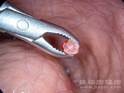 胃镜活检与胃镜检查同步完成。胃镜插入胃内找到病变部位后，医生通过活检通道送活检钳，钳取几毫米病变组织，过程仅几秒