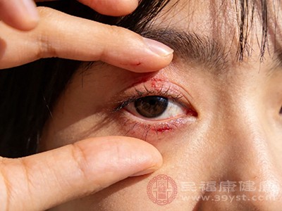 眼周发红、瘙痒、脱皮，眼睑边缘有小丘疹