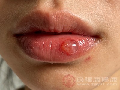 一旦出现疱疹，首要任务是做好局部护理，避免加重症状或传染他人。尽量不要用手抓挠、挤压水泡，以免导致病毒扩散或引发细菌感染