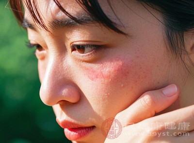 干燥性皮炎多累及面部、四肢等暴露部位，初期表现为皮肤紧绷、粗糙，伴随轻微瘙痒，尤其洗脸后或夜间更为明显