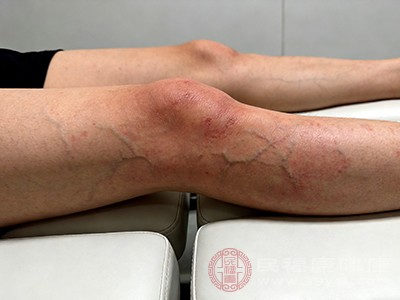 骨髓炎能治好吗 一文给你吃下定心丸