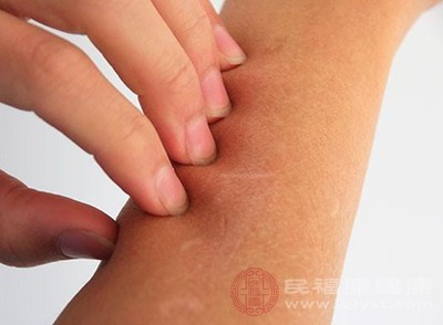 过敏反应可能会引起皮肤瘙痒、红肿、呼吸困难等严重症状