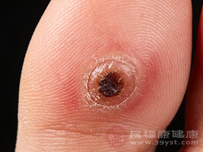 鸡眼通常呈圆形或椭圆形，大小不一