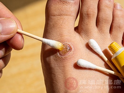 外用药物是治疗鸡眼的常用方法之一