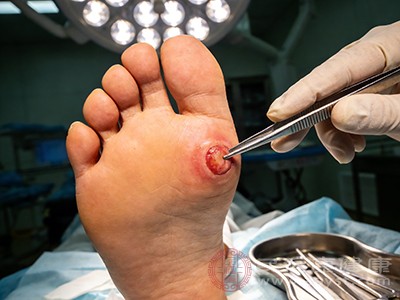 手术切除“一劳永逸”