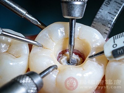医生需要使用各种器械对牙齿内部进行清理、消毒和填充