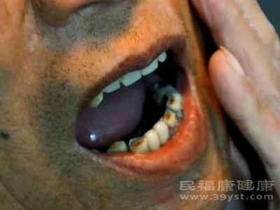 如果在治疗后的日常生活中，不注意保护牙齿，咬了过硬的食物，可能会导致牙齿劈裂，引起牙疼。