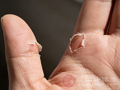 手脱皮 可能是这些维生素在“闹脾气”