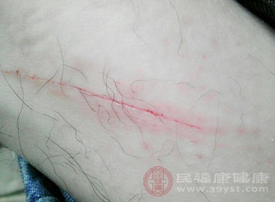 受伤后别乱吃 这几类食物会让伤口愈合“拖后腿”