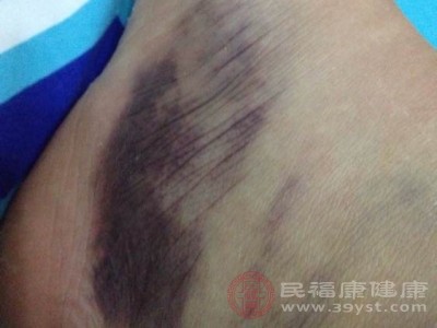 在疾病早期，常见的表现为皮肤瘀点、瘀斑