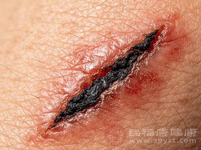 黑疤退退退 应对擦伤后疤痕变黑的实用攻略快收藏
