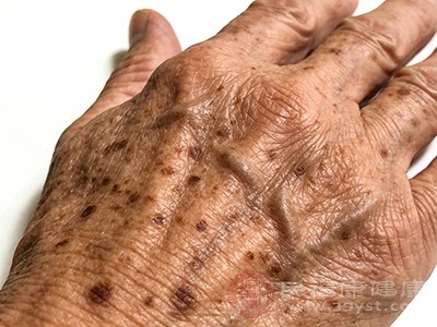 别让老人斑“赖”手上 教你几招轻松“赶跑”它
