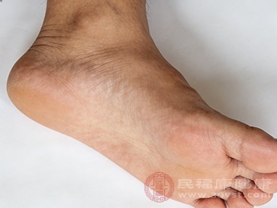 每个人的足部结构存在差异，扁平足和高弓足是较为常见的足部畸形，容易引发左脚底板疼痛