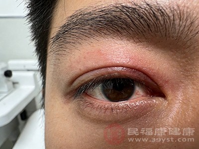 泪洒当场后肿成这样 这些急救法还你明亮双眸