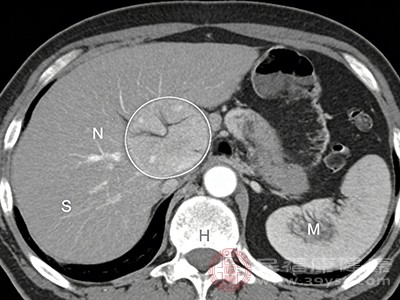 肾囊肿找上门别慌 这份应对指南助你“稳操胜券”
