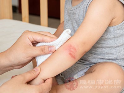 蚊子偷袭宝宝别发愁 这些方法让肿包快速退退退