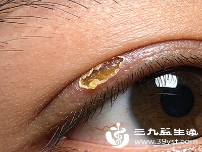 同时分泌物增多，眼屎呈白色丝状或颗粒状，严重时还可能导致眼部炎症。