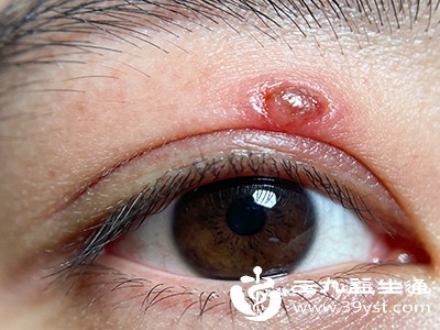 别让眼角疙瘩“赖着不走” 这些招教你轻松应对