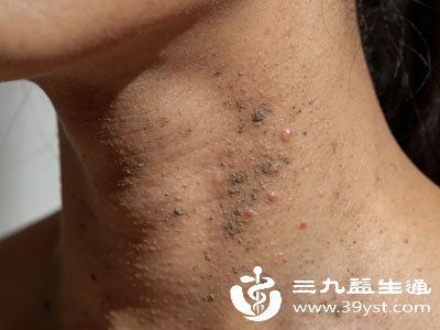 不注意颈部皮肤清洁，污垢