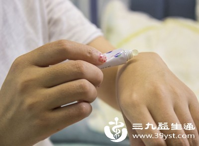 湿疹反复发作愁坏了 这几个“治本”技巧偷偷藏不住