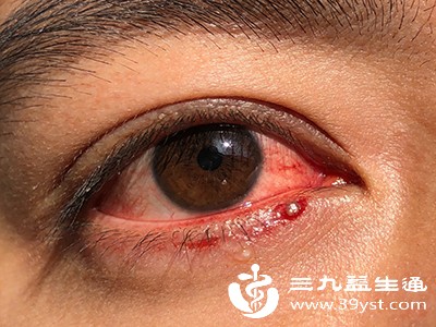 眼睛里藏“血案” 这些原因让眼底血管“突然罢工”