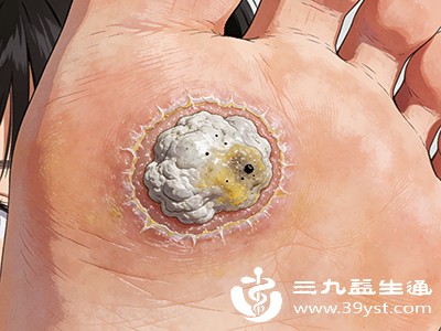 美甲拖鞋都背锅 女生脚底长疣的真实原因藏在这里