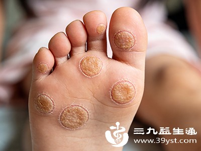 足部卫生不佳——病毒滋生的“温床”