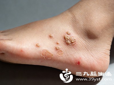 虽然遗传因素在脚底长疣中所起的作用相对较小，但也不能完全忽视。
