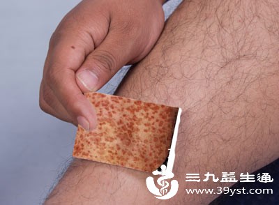 从硬下疳到皮疹 教你破译梅毒“潜伏的身体密码”