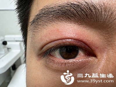 眼部损伤与结膜炎