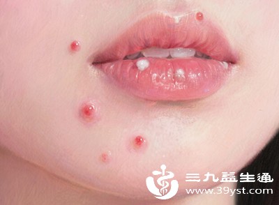 在激素水平不稳定的时候，皮肤也会变得更加敏感。此时，如果再吃辣，可能会加重皮肤的负担，导致痘痘的产生。