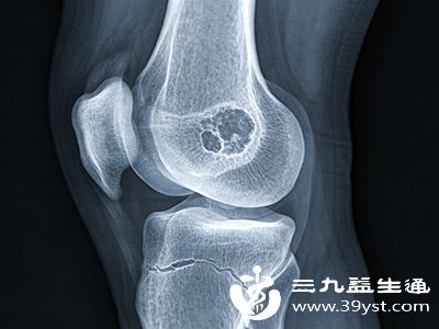 早期股骨头坏死还会导致髋关节活动受限。