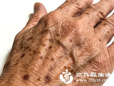 身体内部的一些生理变化也与老人斑的形成息息相关