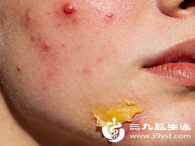 别让红印赖着不走 这些温和又实用的去印方法快收好