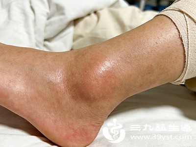 脚踝肿成“小馒头” 分分钟教你快速“消消乐”