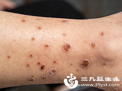 另外,部分年轻人可能会出现皮肤颜色改变,如小腿胫前出现褐色斑疹 另外,部分年轻人可能会出现皮肤颜色改变,如小腿胫前出现褐色斑疹