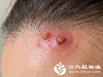 头皮疙瘩反复冒 一文揪出那些“深藏不露”的原因