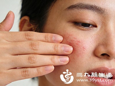 例如，女性在生理期、孕期或更年期，体内激素水平波动较大，容易出现皮肤问题，包括脸上发痒