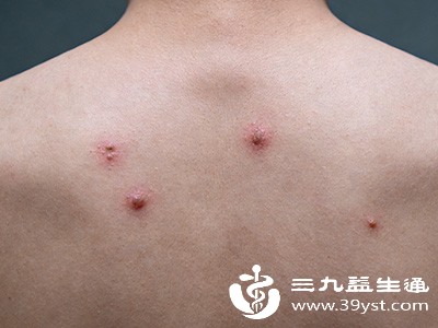 身上莫名长痘咋回事 深度剖析背后“真凶”