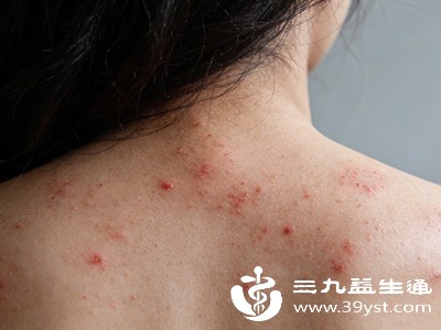 皮肤表面常驻的痤疮丙酸杆菌，在毛孔堵塞时会“伺机而动”