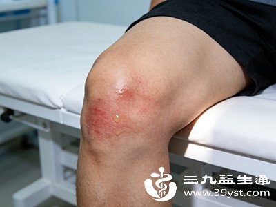 如果滑膜炎症状较为严重，疼痛、肿胀持续不缓解，应及时就医。