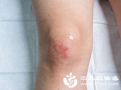 病情的轻重是决定膝盖滑膜炎能否自愈的关键因素之一 病情的轻重是决定膝盖滑膜炎能否自愈的关键因素之一