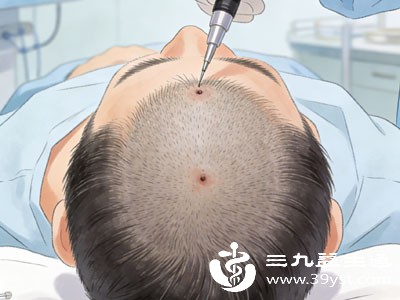 脱发星人救星来了 一文揭秘毛发种植到底有没有用 