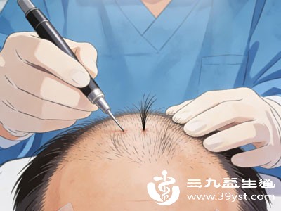 雄激素性脱发 雄激素性脱发