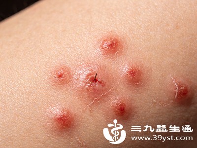 跳蚤还可能隐藏在居住环境的各个角落。 跳蚤还可能隐藏在居住环境的各个角落。