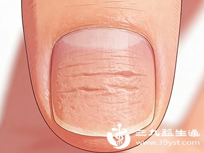 指甲“闹情绪”现横纹凹陷 这些原因快揪出来！